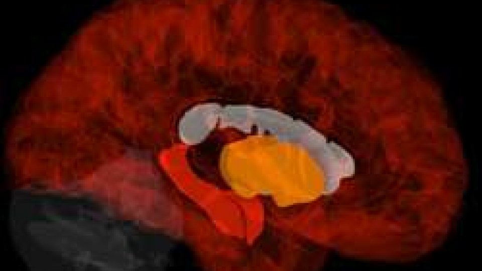 Alzheimer: scoperta l'origine nell'area del cervello che regola l'umore